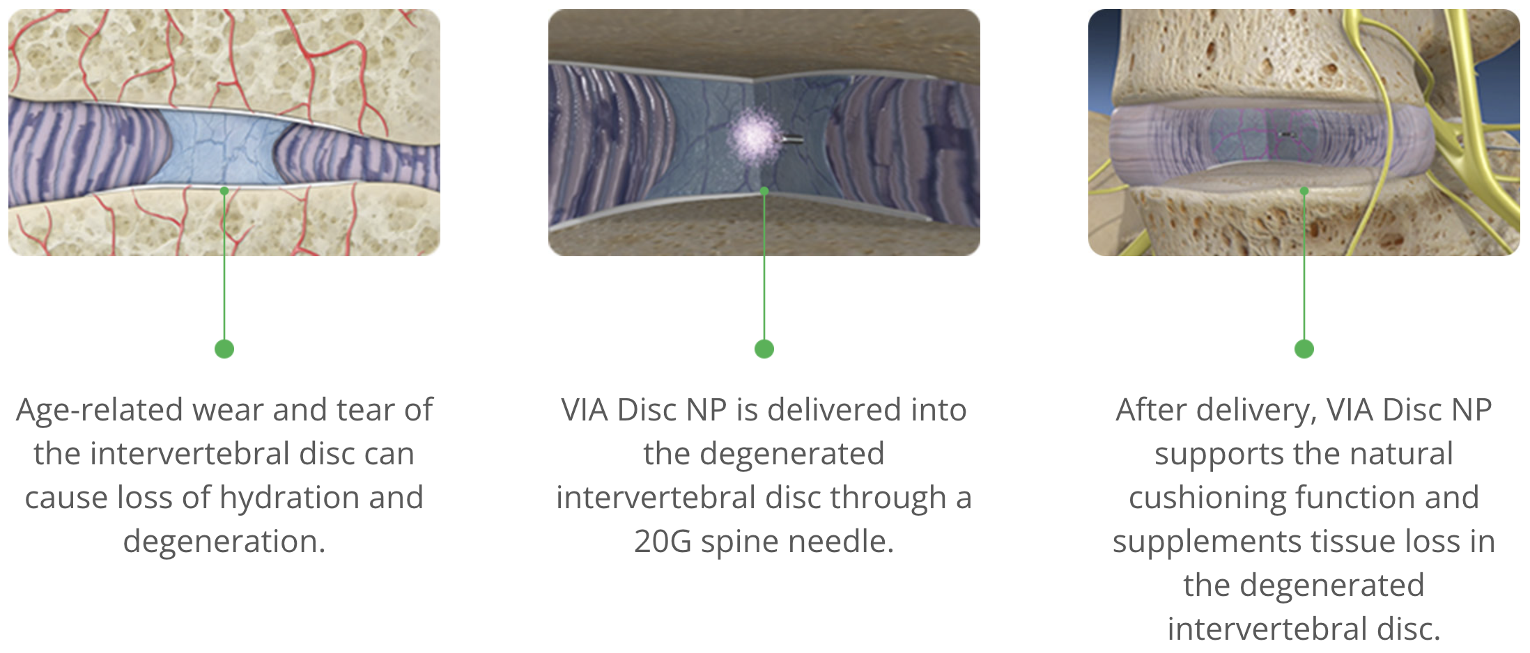 Screenshot 2023-05-10 at 12.23.32 PM before, during and after results of VIA DISC NP application into an aged, painful spine, showing pain relief after treatment