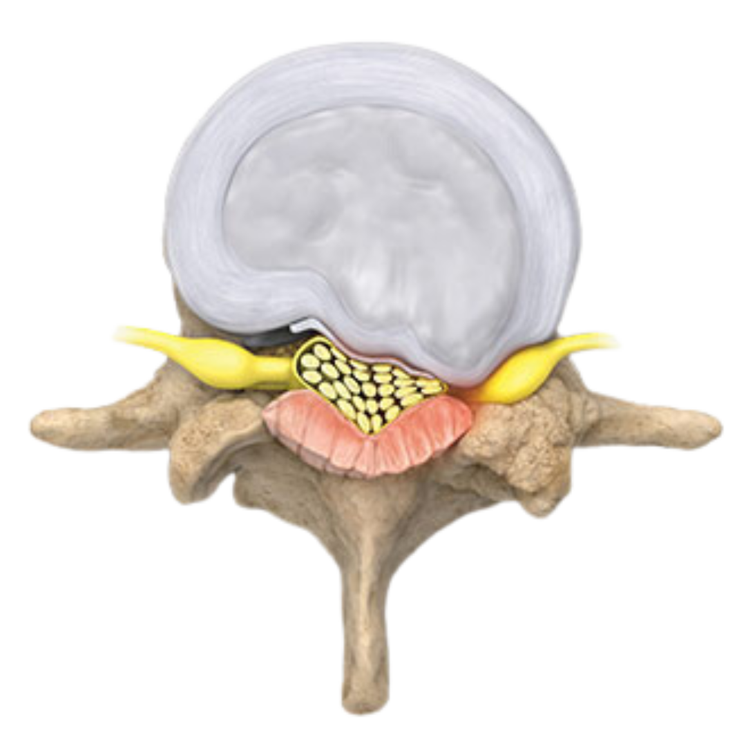AGING SPINAL CANAL WITH STENOSIS aging spinal canal with spinal stenosis