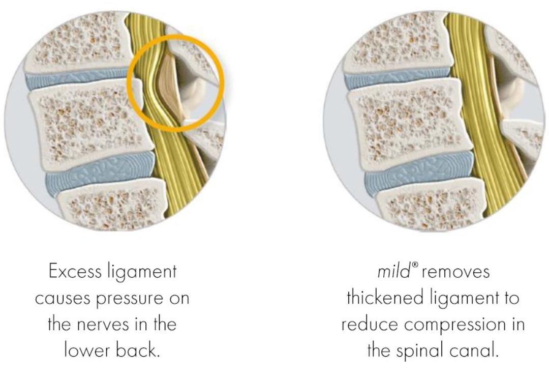 Before and After before and after effects of Mild treatment showing reduced pain and pressure in the spinal canal